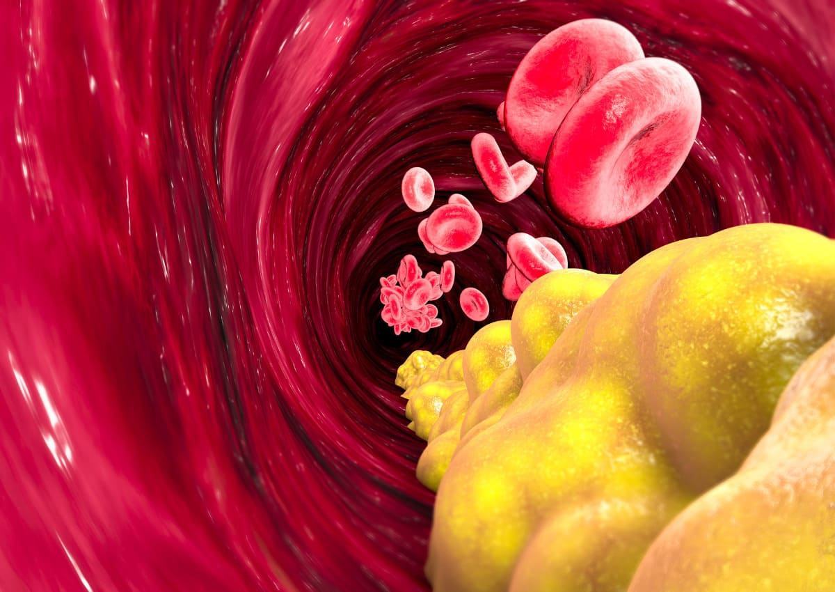 Cholesterol cao nguy hiểm ra sao và bí quyết ổn định cholesterol trong máu 35 Như thế nào là cholesterol cao