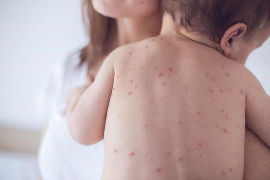 chăm sóc trẻ bị thuỷ đậu