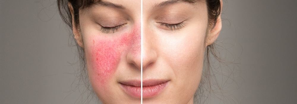 lý do nên chăm sóc da sau laser lý do cần chăm sóc da sau laser