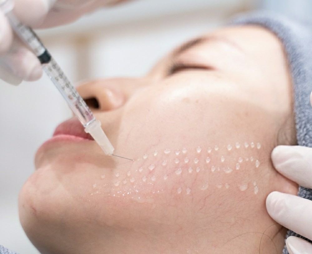 ưu điểm của phương pháp tiêm meso ưu điểm của tiêm meso