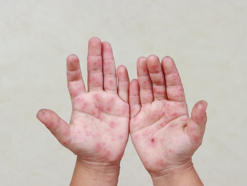 tìm hiểu bệnh sởi ở trẻ em bệnh sởi ở trẻ em là gì