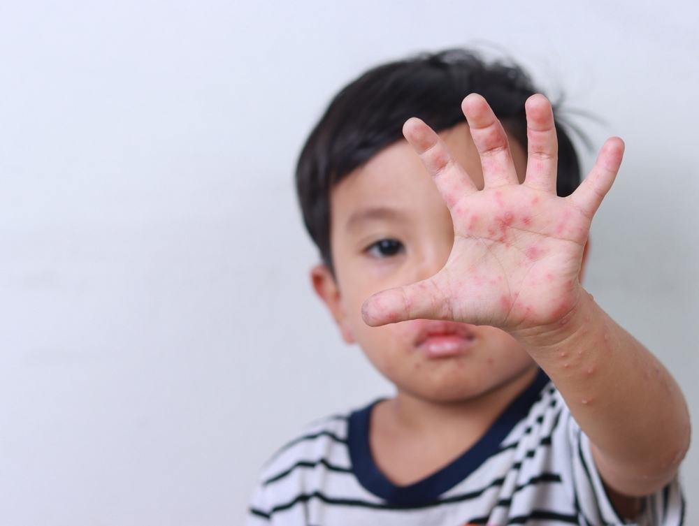 bệnh sởi ở trẻ em có lây lan không bệnh sởi ở trẻ em có lây truyền không
