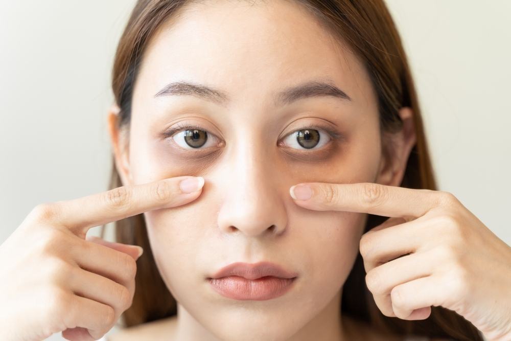 trị thâm quầng mắt sau 1 đêm và nguyên nhân gây quầng thâm mắt trị thâm quầng mắt sau 1 đêm và nguyên nhân gây thâm mắt