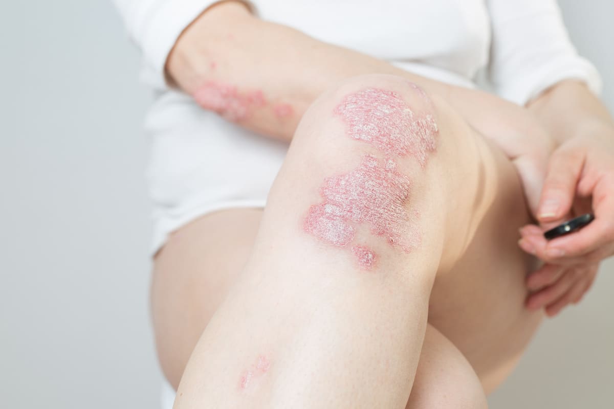 Bí quyết giảm ngứa ngáy do bệnh vẩy nến, giúp bạn dễ chịu hơn 36 tổng quan bệnh vẩy nến là gì