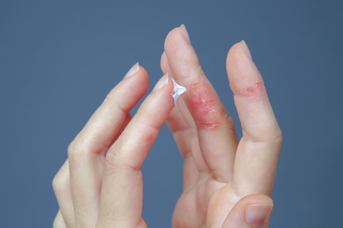Bí quyết giảm ngứa ngáy do bệnh vẩy nến, giúp bạn dễ chịu hơn 38 cách giảm ngứa khi mắc bệnh vẩy nến