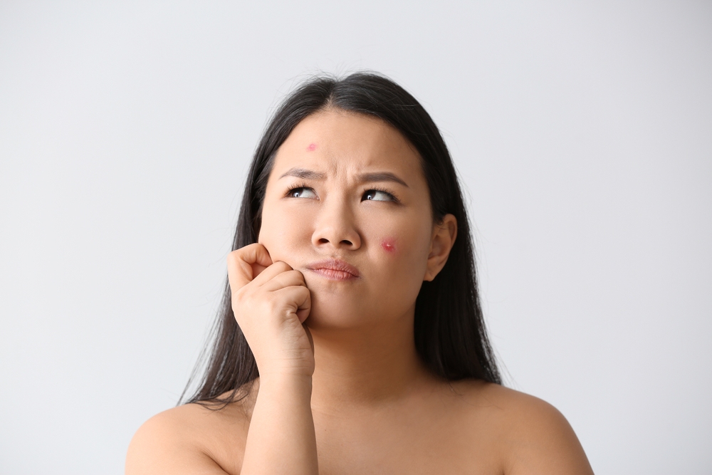 cách làm xẹp mụn sưng đỏ sau 1 đêm
