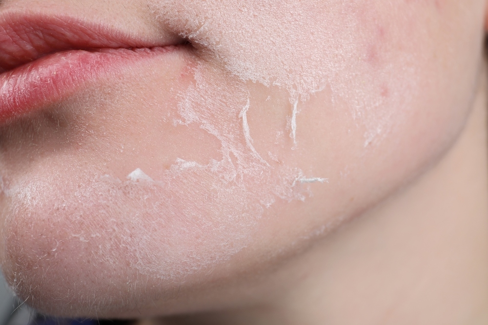 tại sao cần chăm sóc da sau peel vì sao cần chăm sóc da sau peel