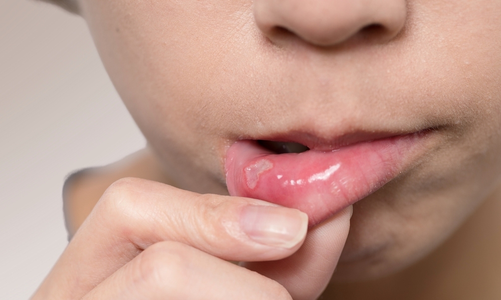 cách chữa nhiệt lưỡi tại nhà và tìm hiểu về nhiệt lưỡi và nguyên nhân gây ra cách chữa nhiệt lưỡi tại nhà và hiểu về nhiệt lưỡi và nguyên nhân gây ra