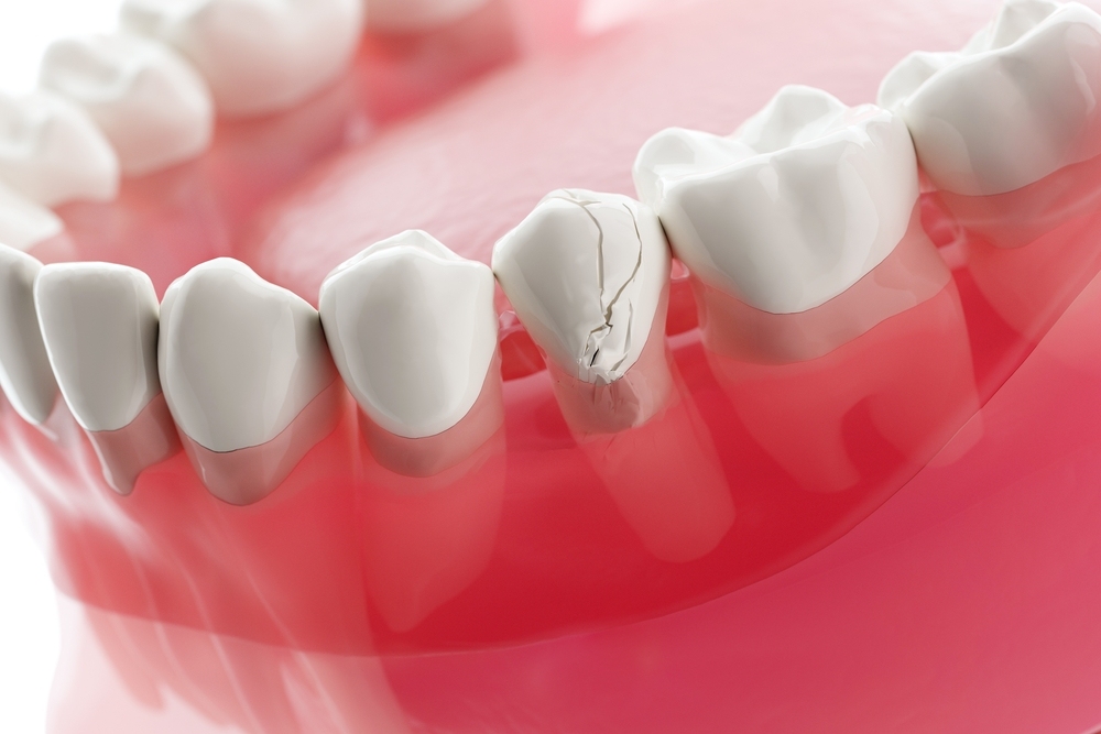 tìm hiểu những cách phục hồi răng bị mẻ tại nhà tìm hiểu cách phục hồi răng bị mẻ tại nhà