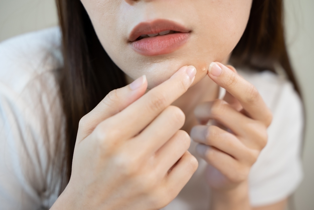 bí quyết chăm sóc da sau khi lấy nhân mụn cách chăm sóc da sau khi lấy nhân mụn