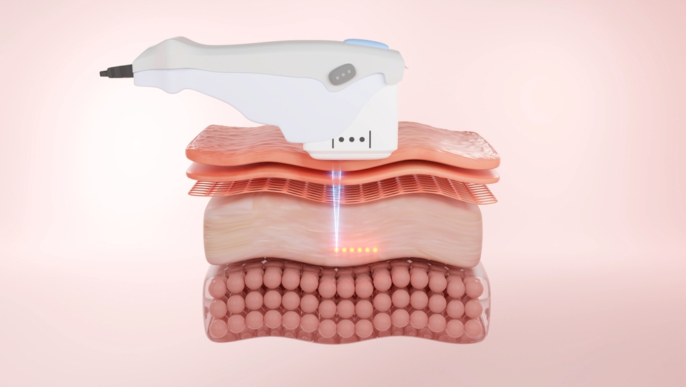 tìm hiểu về tác hại của nâng cơ HIFU tìm hiểu tác hại của nâng cơ HIFU